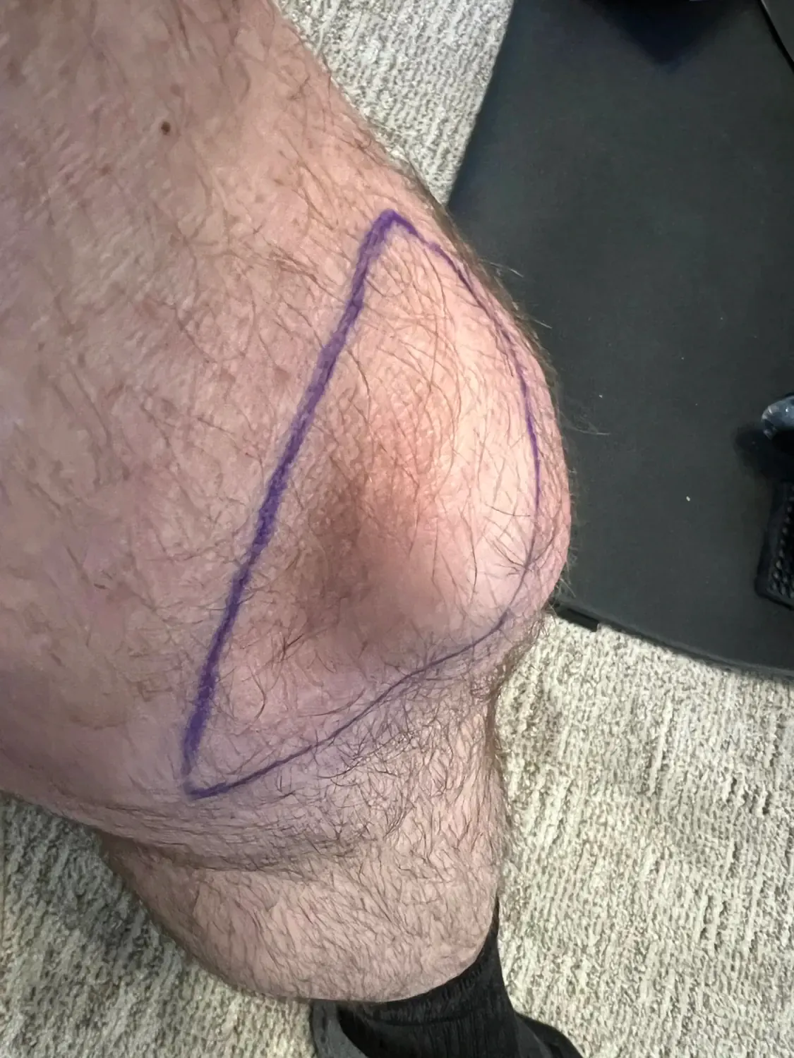 Keith received a shockwave treatment on the highlighted area of his knee to treat the sprained ligament.